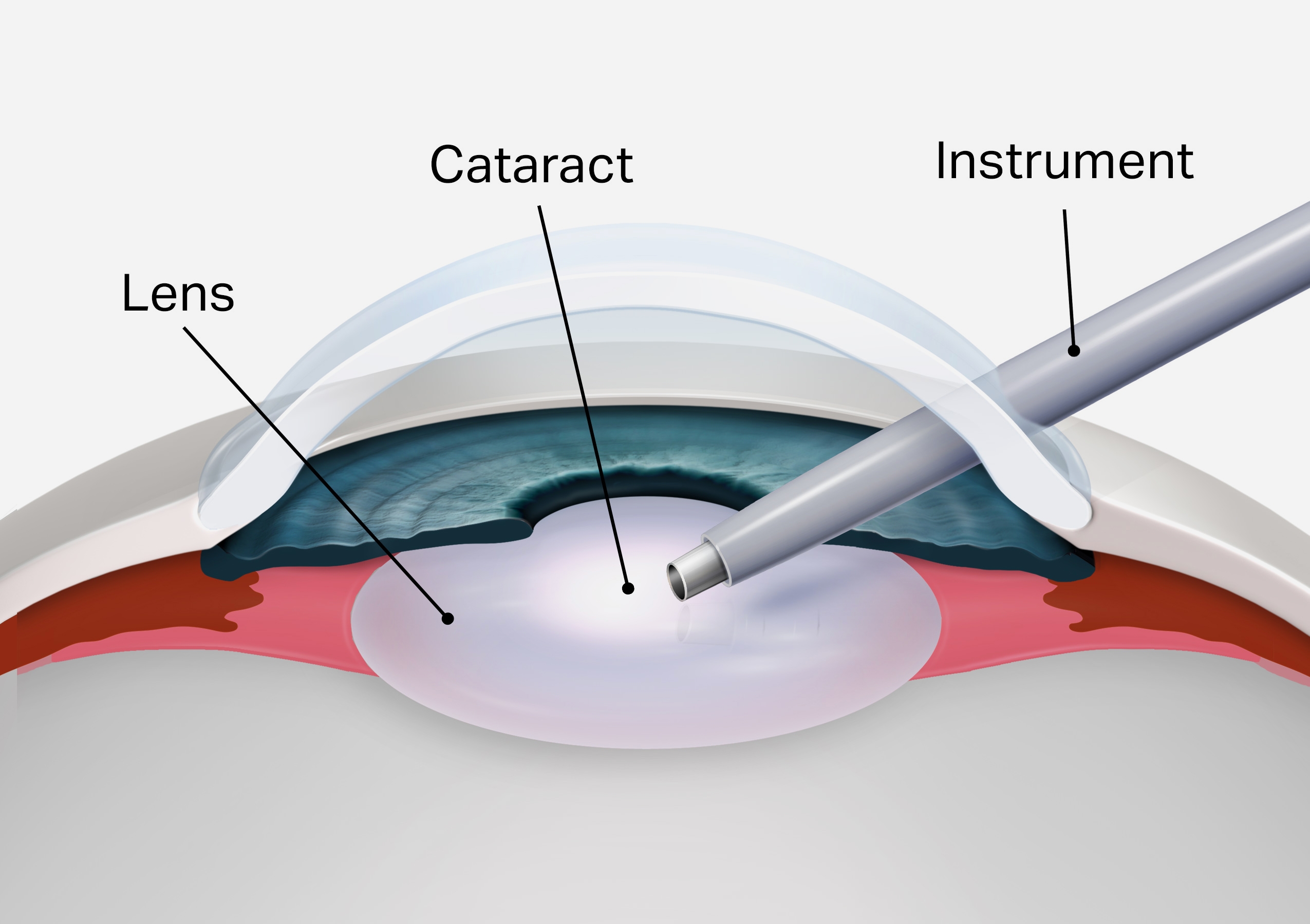 Что после катаракты нельзя делать. Катаракта факоэмульсификация. Хрусталик глаза. Искусственный хрусталик.