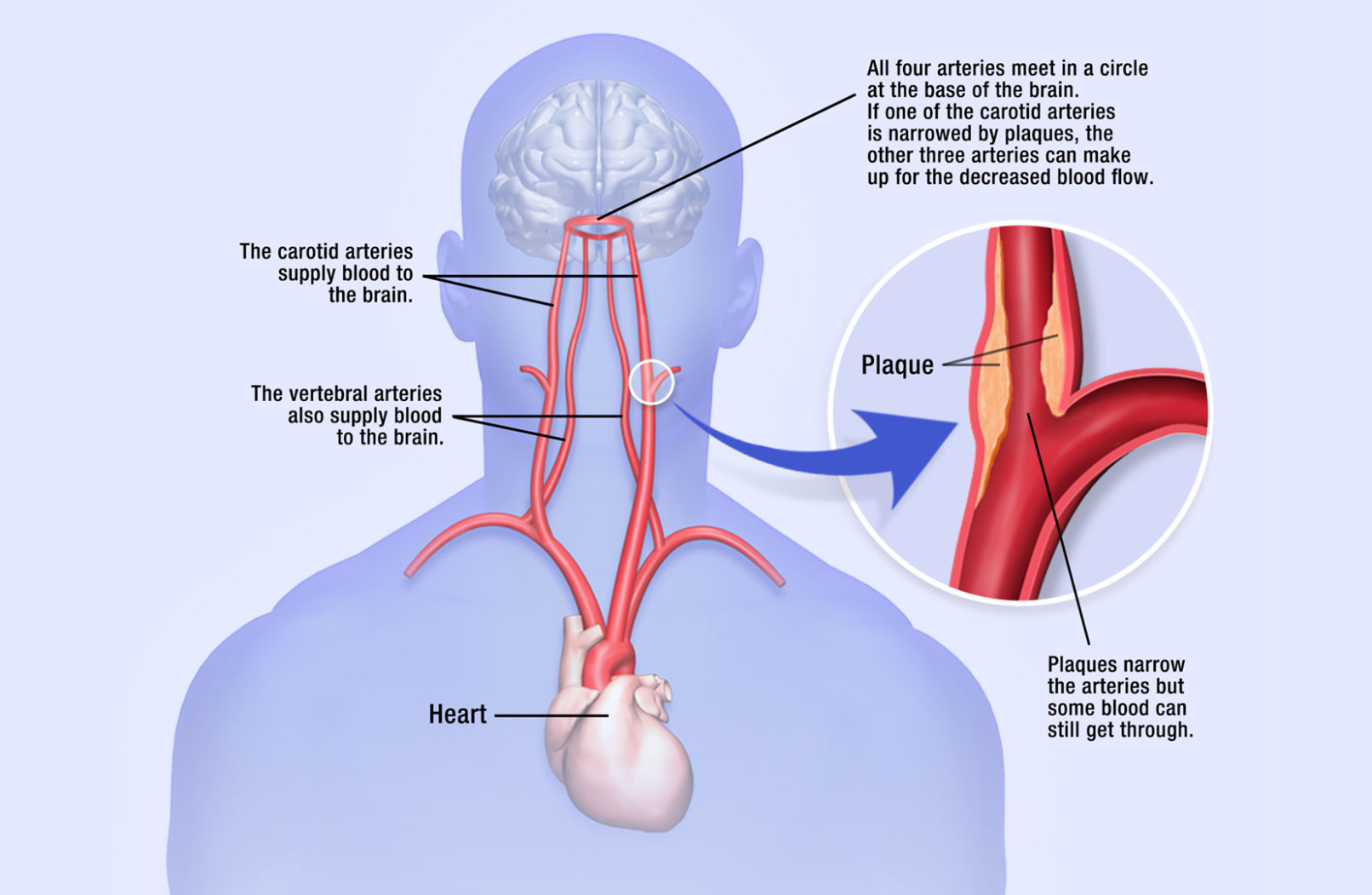 +medical illustration. carotid arteries.