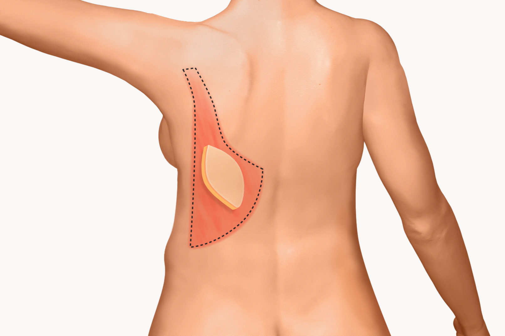 +medical illustration +Latissimus Dorsi Flap