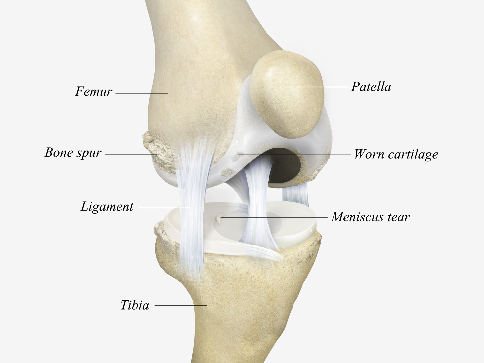 Knee Osteoarthritis Illustrations 
