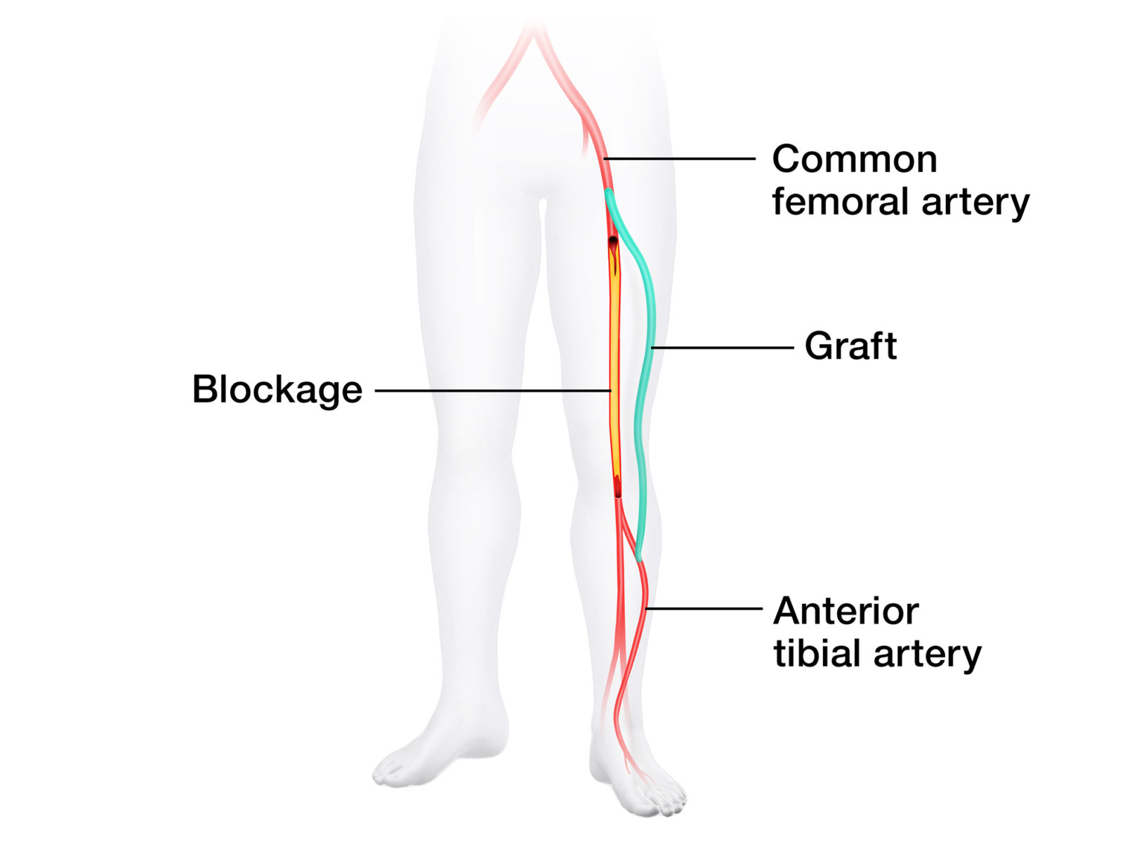 +medical illustration PAD illustrations