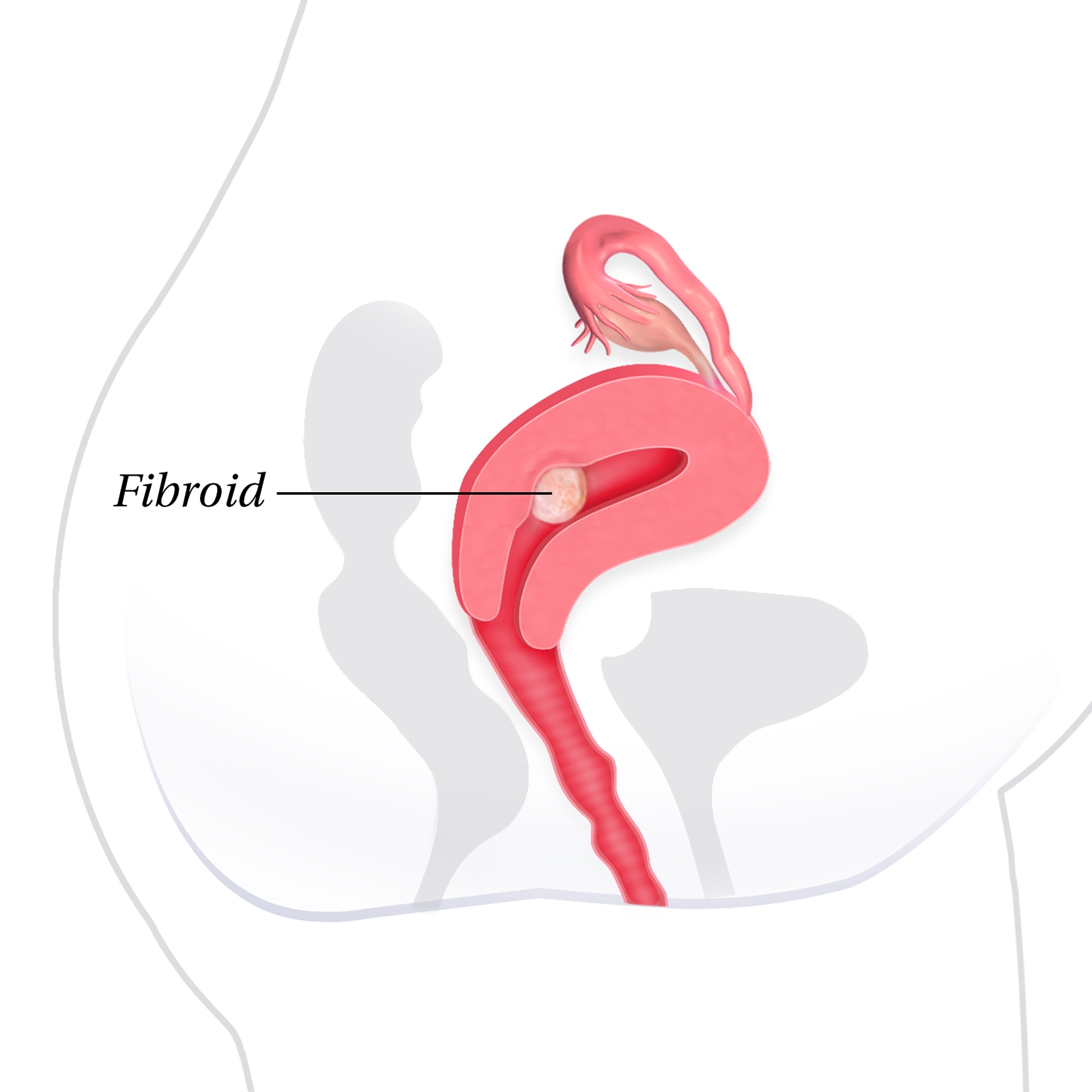 +medical illustration +uterine fibroid
