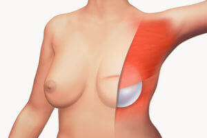 +medical illustration +breast implant