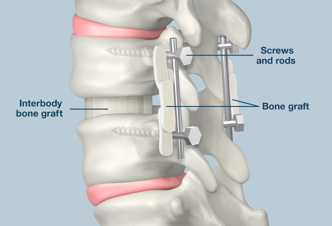 + medical illustration +spinal fusion