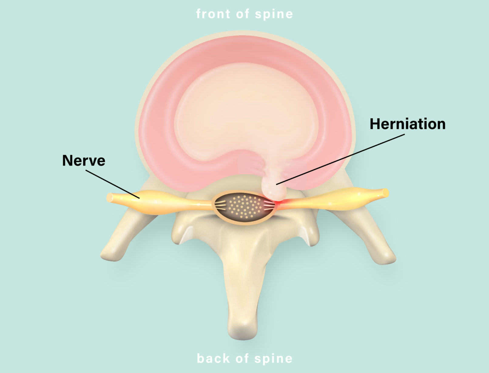 +medical illustration +herinated disc